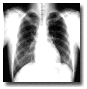 胸部X光圖